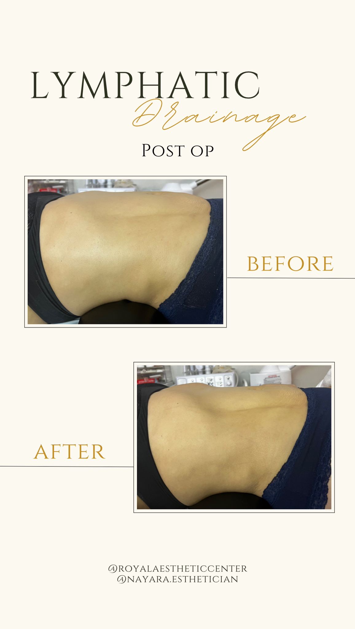 Lymphatic massage results. Before and after images.
