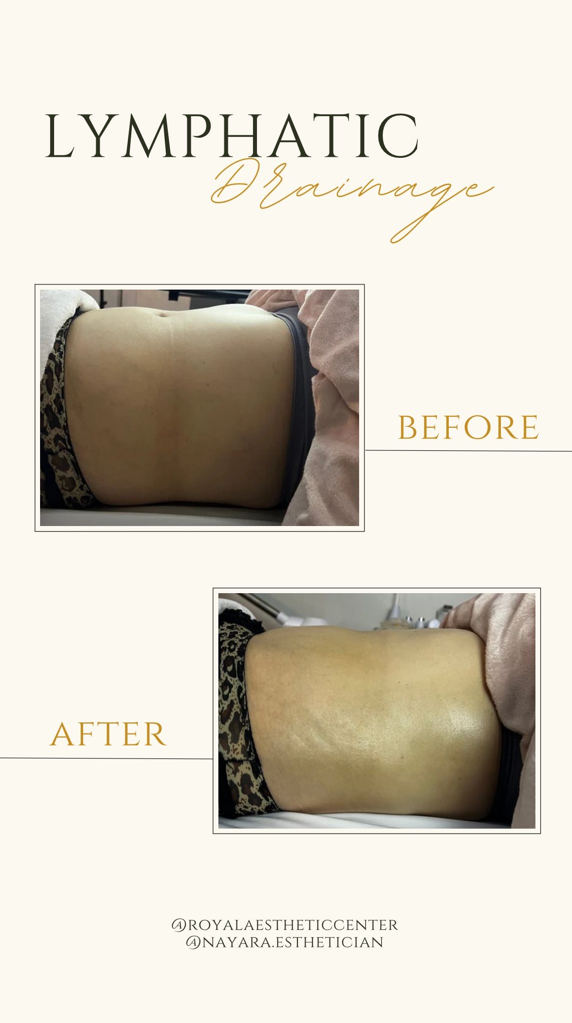 Lymphatic massage results. Before and after images.